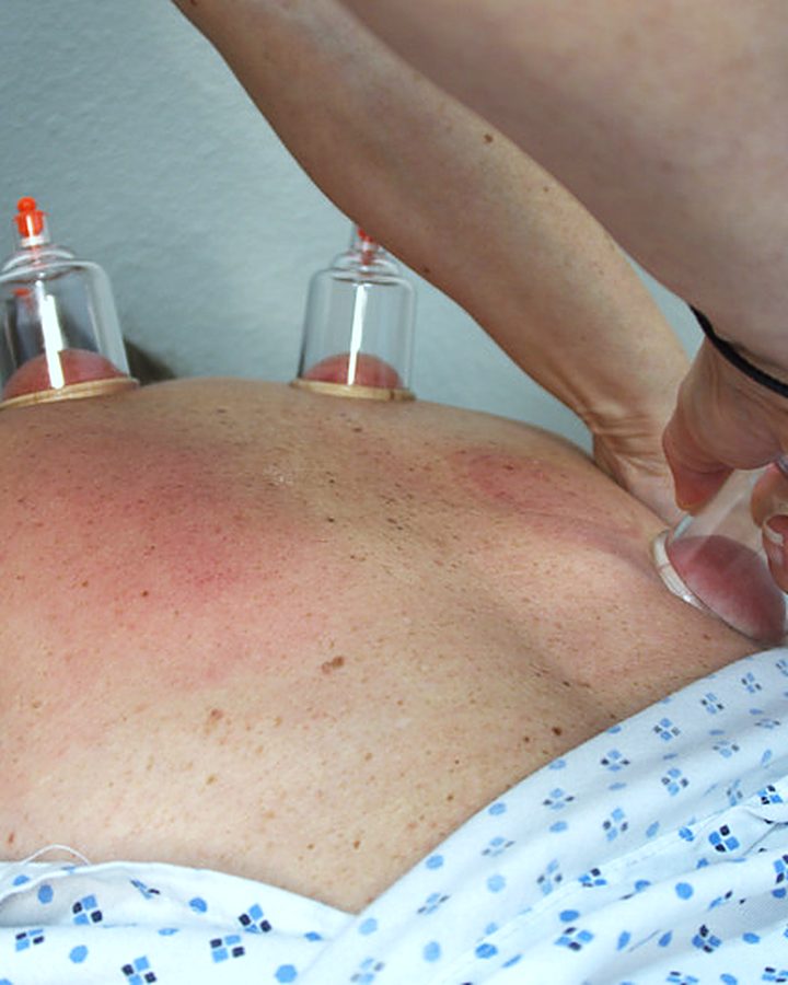 Cups placed during a cupping session
